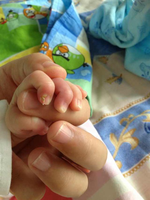 13天新生儿,手指指甲与肉之间有小包,附图