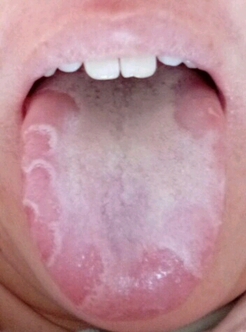 你好,我想问一下我的舌头像图片这样,是怎么回事?