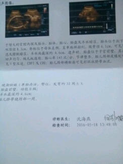 怀孕快八个月了,做了b超胎位是臀位,还有脐带绕颈部一周,这样对胎儿有