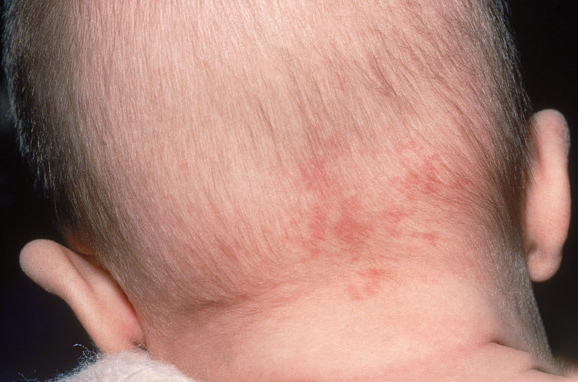 宝宝的这几种胎记可能会癌变  红色的胎记 新生儿红斑 出生后 2～3 天