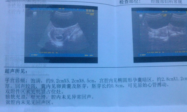 49天b超归来,大家看看像男宝还是女宝啊?