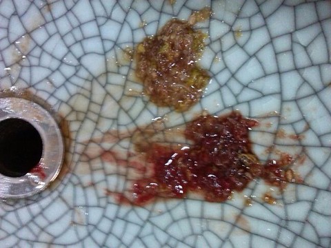 有宝妈和我一样孕吐时吐出血的么?挺害怕