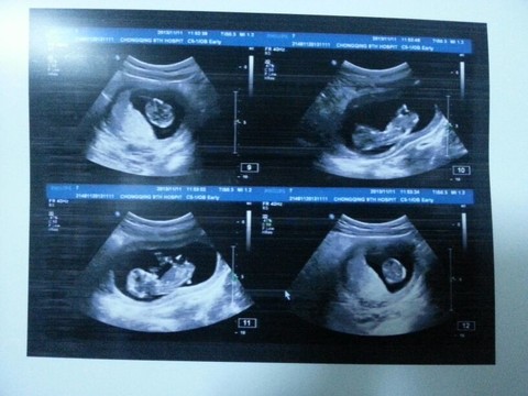 怀孕12周彩超图图片