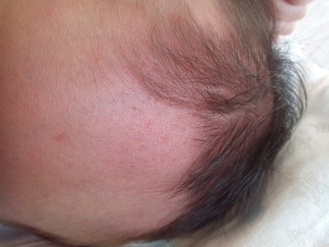 婴儿头部湿疹图片