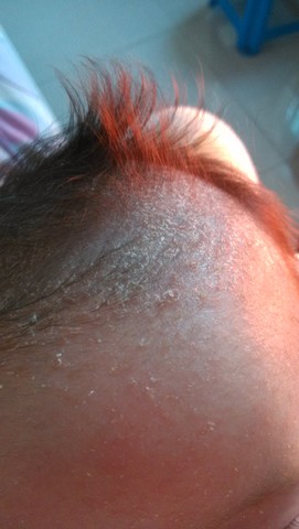 头皮起皮了,有图,有一样的吗?什么方法洗干净?