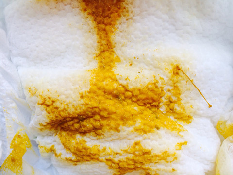 纯母乳,便便里有如图粘丝正常吗?