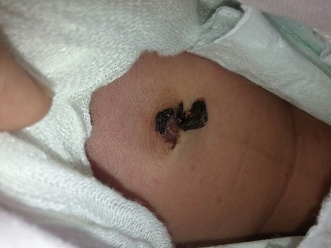 新生儿脐带正常的图片图片