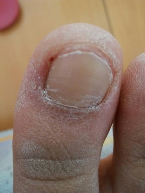 脚趾甲长在肉里面了