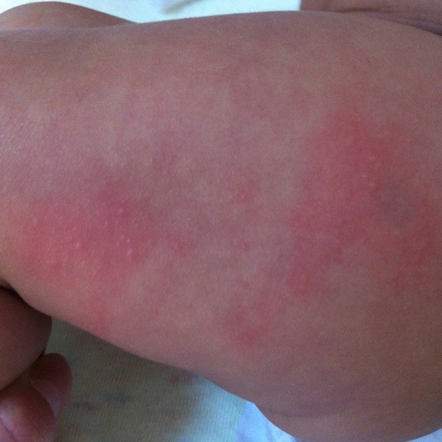因为我家宝宝长过湿疹不是这样的!测过体温,373