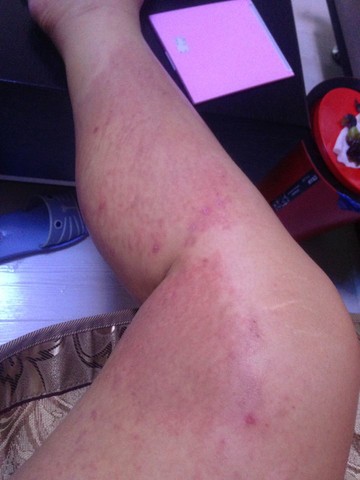 奇痒难耐的puppp妊娠瘙痒性荨麻疹样丘疹及红斑