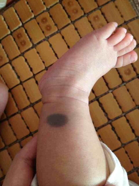 你家宝宝有胎记吗?