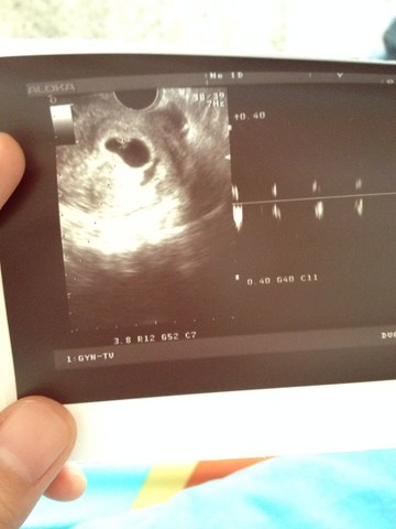 怀孕六周b超子宫内有积血 求大夫解救 谢了 宝宝树