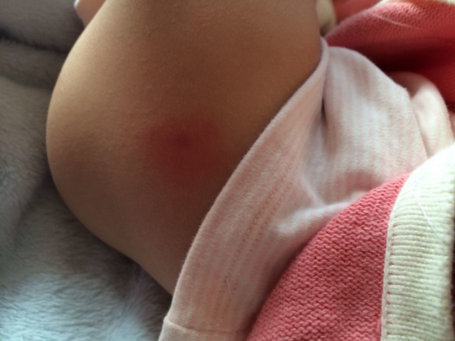 女宝宝下面长红疙瘩,还有大腿长红疙瘩是什么?怎么办?