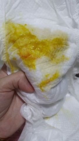 我宝宝大便裏面有血丝,也是肛裂了,医生让擦金