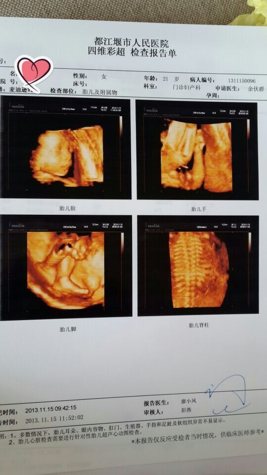 正常胎儿四维脊柱图图片