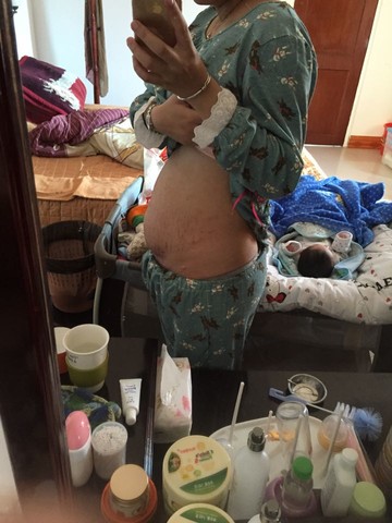 剖腹产18天的伤口.