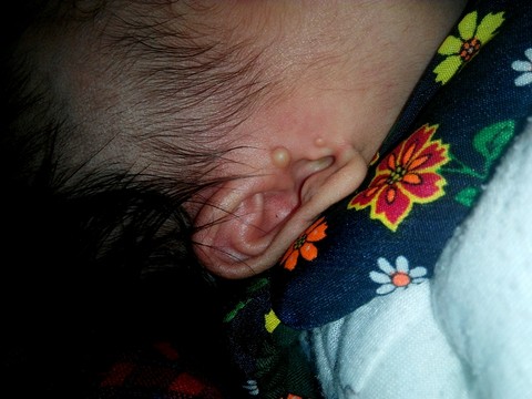 宝宝耳朵上长了两个小耳朵怎麼办