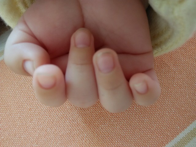 宝宝55天,皮肤白,可今天发现手指头前面发黄,知道咋回事