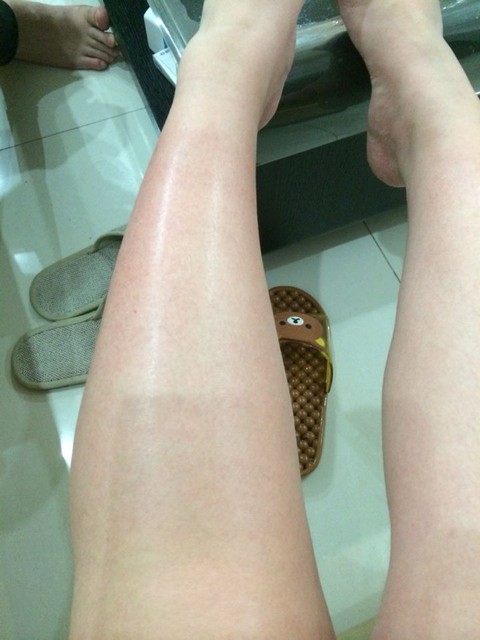 孕晚期,小腿变红