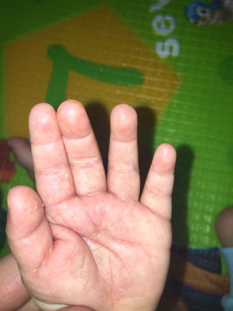 宝宝手指头蛋蛋忽然这样了,怎么回事?在线等!