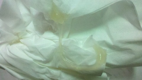 我分泌物像鼻涕一样粘稠正常吗