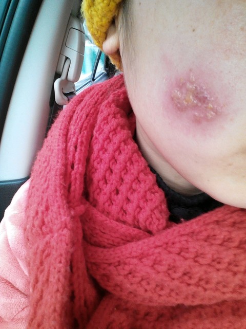 有没有起过疱疹的,能治好吗