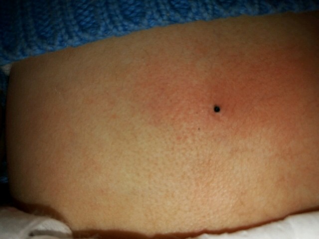 紧急宝宝突然长了个黑点.昨天洗澡都没有.付图一张