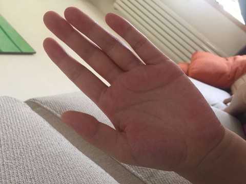 有没有宝妈手心儿也这么红的?
