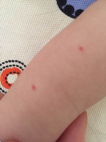 求助亲们帮我看看宝宝胳膊上的小红点是怎么了 宝宝树