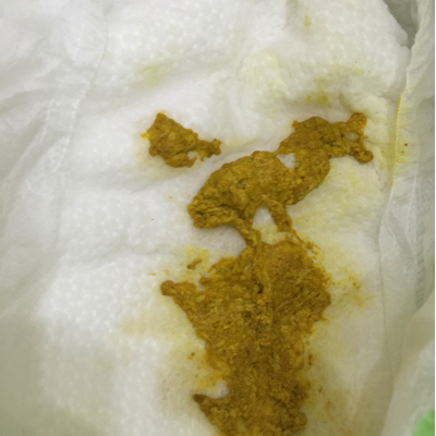 展开阅读全文 春雨医生专家团:大便很好的,黄色软便,稍稍有点小奶瓣