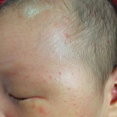 宝宝长了这个红疙瘩,头上也有,这是湿疹么,应该怎麼办?