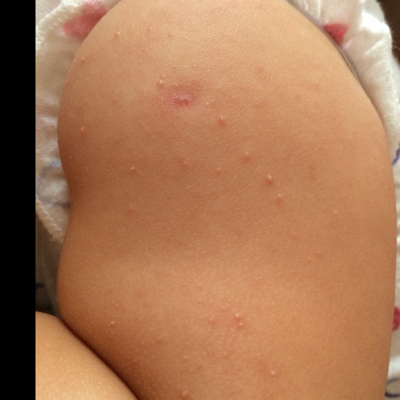 不知道是湿疹还是痱子,还是其他的?求解阿