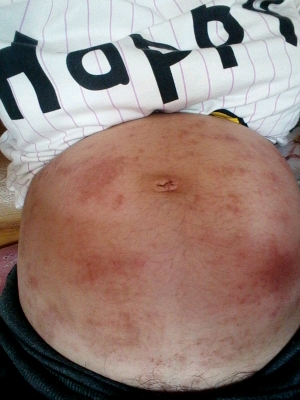 湿疹在结痂了,怎麼还是特别的痒呀?