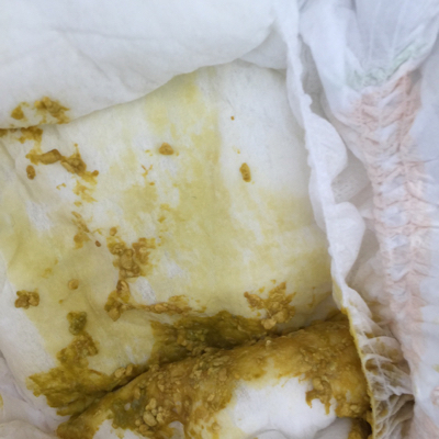 宝宝拉这样的便便是怎麼回事,一天好几次