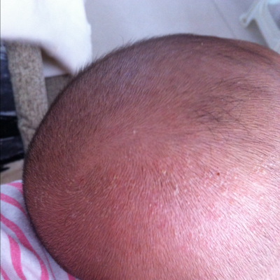 宝宝两个多月 头上和背上好多干皮怎麼回事