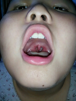 小孩子的喉咙图片清晰图片