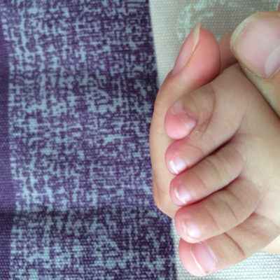 我姑娘出生时脚趾和旁边的指头连着一层皮,我想问一下这个手术什麼