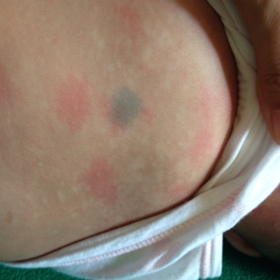 白色是花斑癣嘛?可以用什麼药?