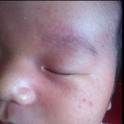 宝宝出生26天,突然眉毛中间出现疙瘩,成片的红色(如图)不知道是什麼