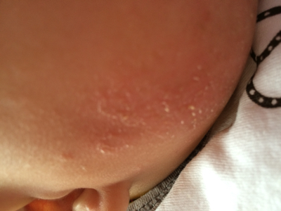 宝宝脸上圆圈癣图片图片