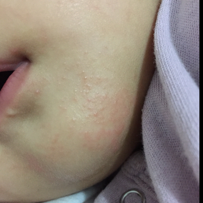 最近宝宝下巴和额头上起的都是一粒一粒的,是什麼知道吗?怎麼办?