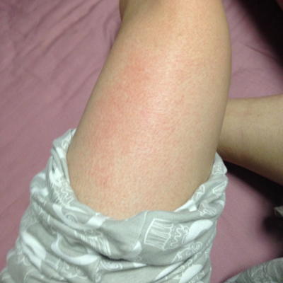 洗澡时发现大腿上一大片发红,不痒,有一点点痛,没有接触过什么过敏源