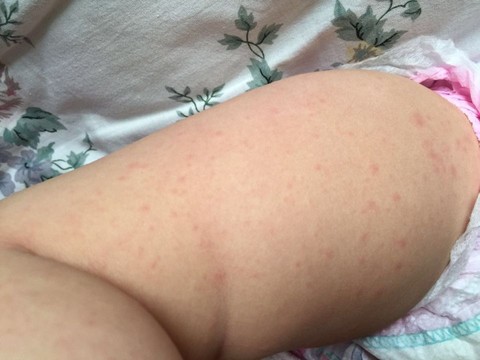 宝宝四肢为什么长了很多小红点 宝宝树