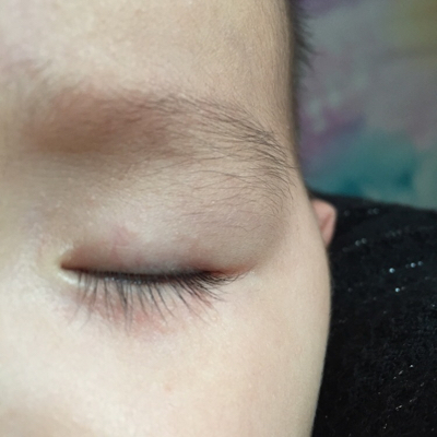 孩子眼下面有红痘痘,两个眼睛都有,求解,七个月了