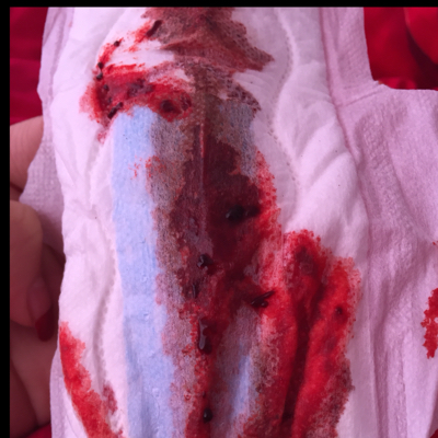 前天就一点点血,昨天晚上有点多了,今天打了黄体酮,吃的中药,这样能保