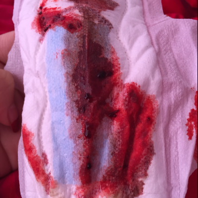 子宫内膜炎出血的颜色图片