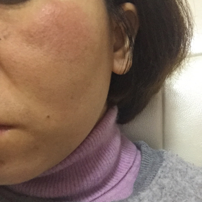 怀孕后脸上长了皮脂皮炎,一般外涂药不敢用,请教有什麼方法治疗