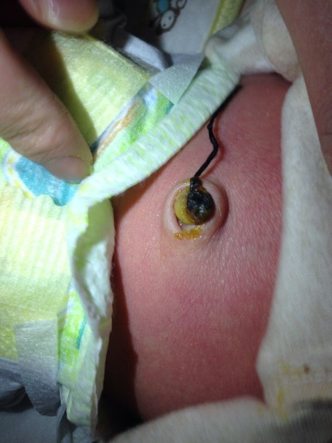 宝妈们帮忙看看脐带是感染了吗