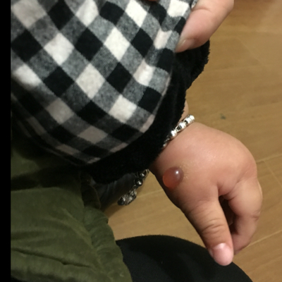 急啊……宝宝七个月,下午不知道什麼原因发现长了个大血泡