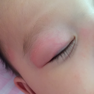 宝宝眼睛被蚊子叮肿图图片
